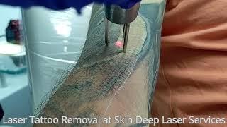 Laser Tattoo Removal Partial Sleeve Treatment for Cover-Up at Skin Deep Laser Services in Burke, VA