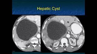 CT Evaluation of Liver Masses: Key Differential Diagnosis Pathways - Part 1