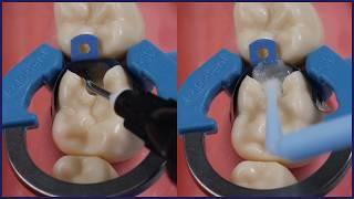 How To: Marginal Ridge Heights in Class II Restorations | Tips From Dr Lincoln Harris