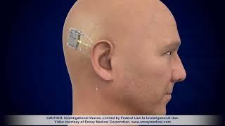 Meet the fully implanted Acclaim® cochlear implant, an investigational device