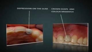Improving and Repairing Bad Teeth Implants