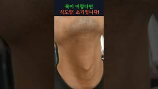 목이 이 증상 있다면, '식도암' 초기일 수 있습니다! 당장 병원가세요! #건강 #건강정보 #목 #식도암 #후두암 #갑상선암
