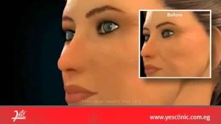 Radiesse Volumizing Filler Animation   Cosmetic Enhancement