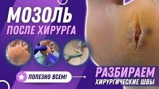 Мозоль после хирурга. Разбираем хирургические швы. Полезно всем! #хирург #разбор #медицина