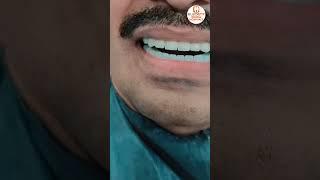 Full Mouth Dental Implants At @EledentDentalHospitals | Best Dental Hospital In India #ytshorts