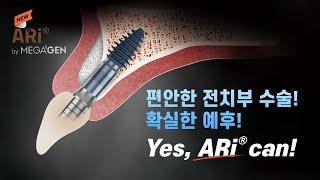 전치부 솔루션, 14년 만의 신제품 'ARi'