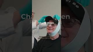 Charlie Sheen - SurgYlift Results