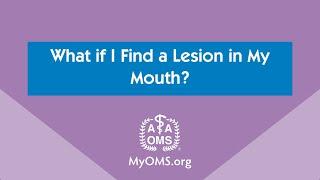 What if I Find a Lesion in My Mouth?