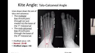 Congenital Vertical Talus In-Depth Lecture on Patho-Anatomy, Presentation, Radiology and Management