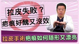 中下臉拉皮失敗疤痕可怕又沒效?! 全層次筋膜拉皮手術原理及疤痕隱形漂亮的原因解析! ｜林敬鈞醫師｜巨星整形外科