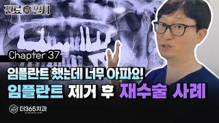 바른 임플란트 식립의 중요성, 임플란트 재수술 사례 | 【더365치과】 진료일지 #37