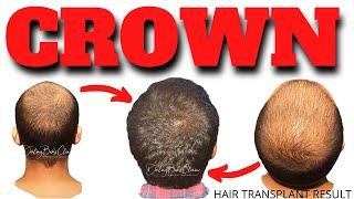 Crown hair transplant result 2021 | Darling Buds Clinic