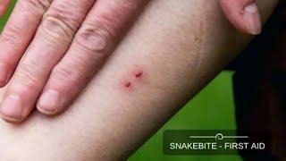 Snake Bite And Management #snakebite