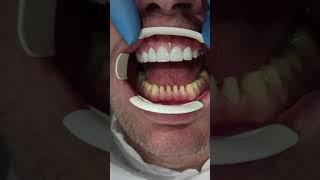 Before and After Zirconium Crowns