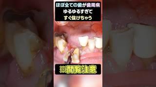 ※閲覧注意　ほぼすべての歯が歯周病でした...【後編】 #歯医者  #dentist #抜歯 #歯石除去 #歯石 #tartar #ショート #shorts