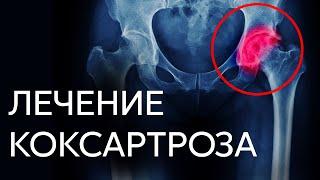 ЛЕЧЕНИЕ КОКСАРТРОЗА | Доктор Черкасов