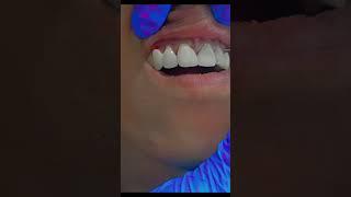 Digital Smile Transformation In One Visit | Eledent Dental Hospitals | Best Dental Hospital In India