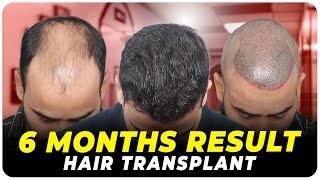 Hair Transplant in USA | Best Results & Cost of Hair Transplant in USA