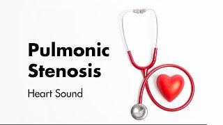 Pulmonary Stenosis (aka Pulmonic Stenosis) - Heart Sounds - MEDZCOOL