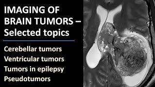 Imaging of Brain Tumors - Selected Topics