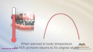 Orthodontic Wire - Nickle Titanium or NiTi