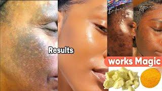 How to apply shea butter and Tumeric on the face/apple shea butter on your skin and see the magice.