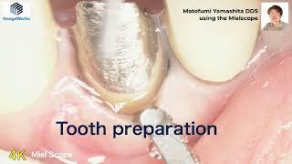 Mielscope - Tooth preparation