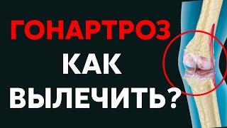 Гонартроз, артроз коленного сустава | Доктор Черкасов