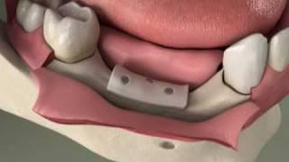 Dental Implants - Bone Grafting - Ridge Preservation in Denville, NJ