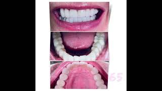 Smile Makeover