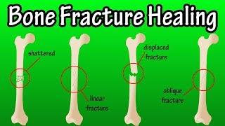 How Does A Bone Break Heal - Bone Fracture Healing Process