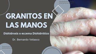 GRANITOS EN LAS MANOS PRURITO Vejiguitas en los dedos  DISHIDROSIS O ECCEMA DISHIDRÓTICO 