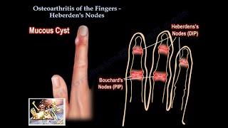 Osteoarthritis Of The Fingers Heberden's Nodes  - Everything You Need To Know - Dr. Nabil Ebraheim