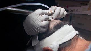 SmartGraft Hair Transplant at The Dermatology Laser and Vein Center