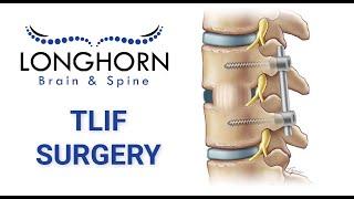 Longhorn Brain and Spine - Robotic-assisted minimally invasive TLIF