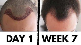 Hair Transplant Results: 7 Weeks Later