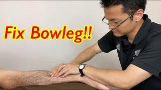 How I treat bowlegs (English)