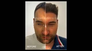 Before and after - Rezultate - implant de par 12 luni #implantpar #implantdepar #beforeandafter