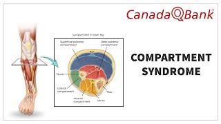 Compartment Syndrome