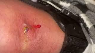 Popping huge blackheads and Giant Pimples - Best Pimple Popping Videos #130