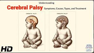 Cerebral Palsy: Identifying Symptoms and Understanding Causes