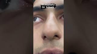 Rhinoplasty in Lahore Pakistan by dr Saleem. #nosejob #bellatuclinic #rhinoplastybeforeandafter