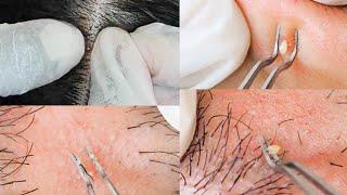 Super-zoomed Face Extractions & Picking Ingrown Hair | Scalp Nitpicking Whiteheads ‍️| ASMR