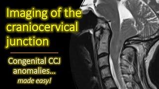 Imaging of Congenital Craniocervical Junction Anomalies.