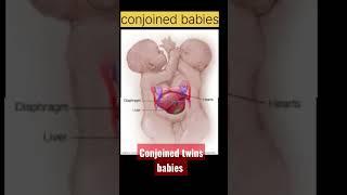 conjoined twins babies