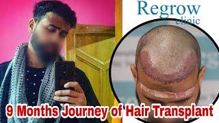 Best Hair Transplant Result 2021 || NW Grade III || 2,812 Grafts ||  @Regrow Clinic ​