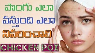 Home remedies for chicken pox in telugu - Chickenpox in telugu - Varicella - ammoru- atalamma- pongu