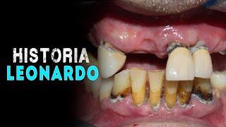 ANTES Y DESPUES IMPLANTES    En 24 Horas cambio radical de SONRISA 