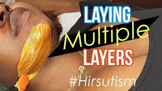 Hirsutism Face Wax | Why Wax An Area Multiple Times? #HirsutismWax