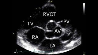 Normal echocardiography, Dr. Wael Elkilany